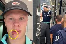 Erling Haaland khâu ba mũi sau tai nạn hy hữu với xe bus